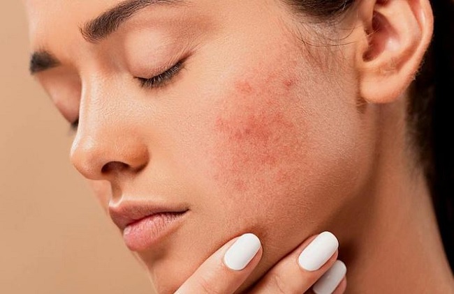 Best Home Remedies to Cure Acne