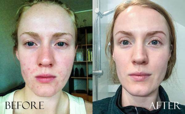 Exposed Skin Care Before & After Pics