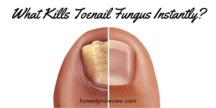 What kills Toenail Fungus Instantly?