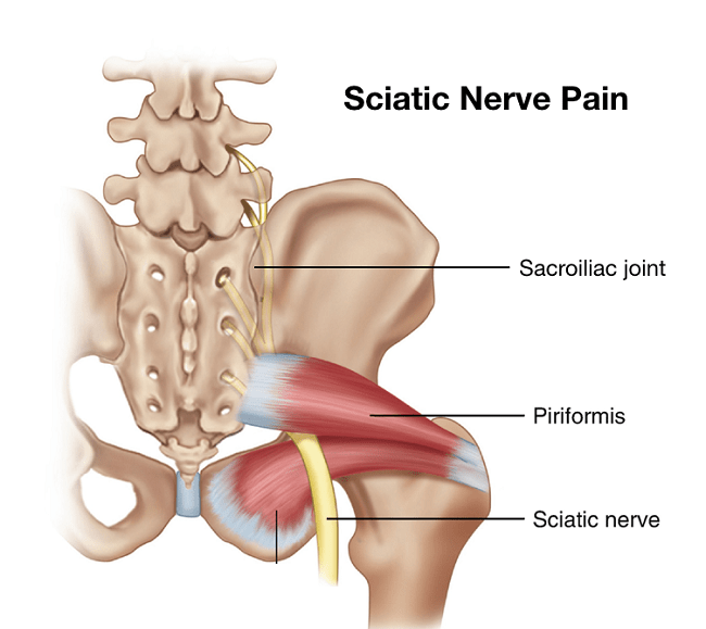 How To Relieve Sciatic Nerve Pain