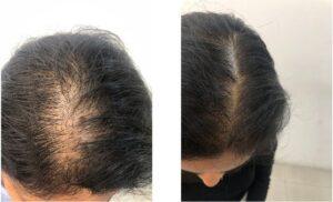 Will My Hair Grow Back