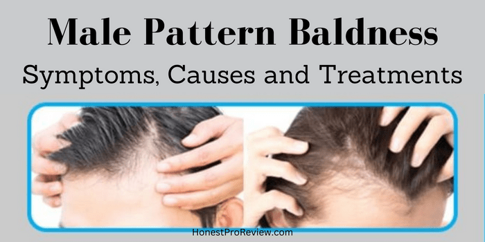 Male Pattern Baldness symptoms causes and treatments