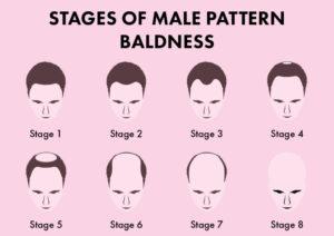 Stages with male pattern baldness