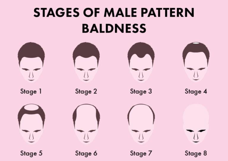 Male Pattern Baldness Symptoms, Causes, and Treatments