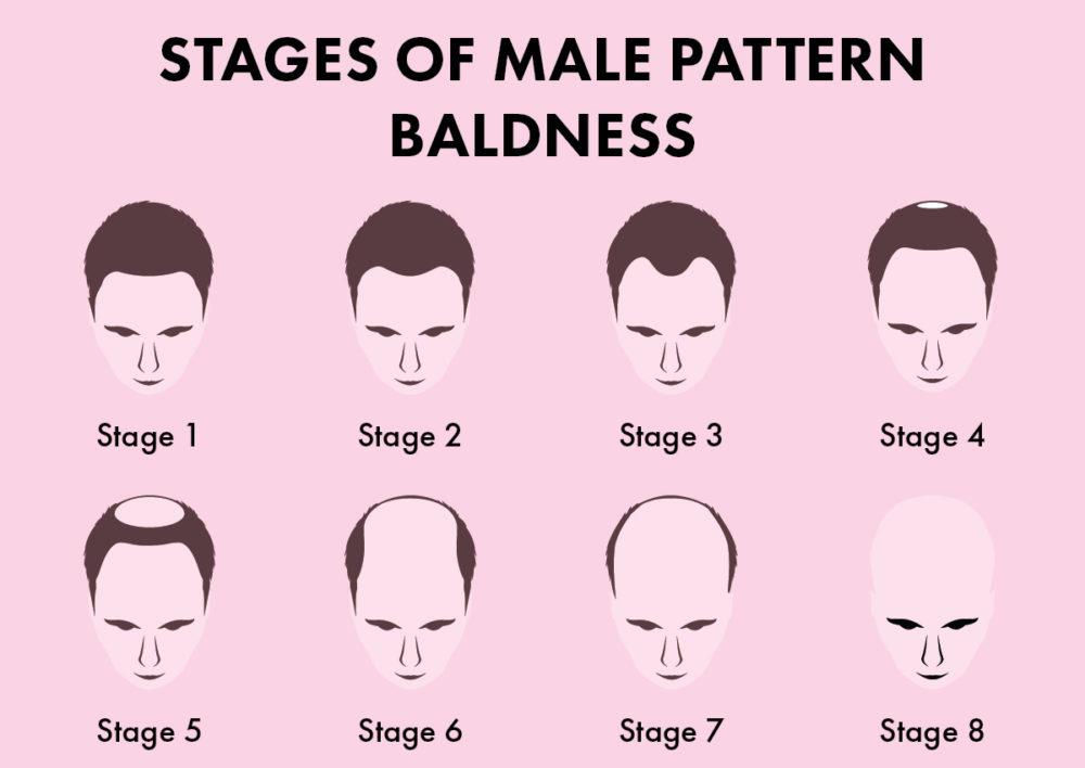 Male Pattern Baldness Symptoms Causes And Treatments